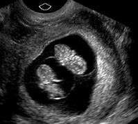 Image result for Ultrasound at 9 Weeks Pregnant