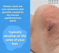Image result for Plantar Wart Pain