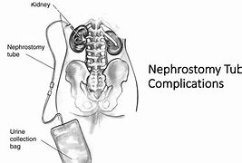 Image result for Nephrostomy Tube vs Urostomy