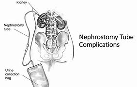 Image result for Percutaneous Nephrostomy Tube Placement
