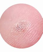 Image result for Molluscum Contagiosum Skin Rash