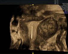 Image result for 5 cm fibroids ultrasound images