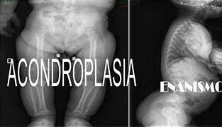 Image result for acondroplasis