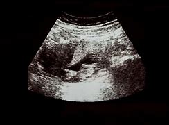 Image result for 9 Week Pregnancy Ultrasound