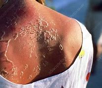 Image result for Skin Peel After Sun Burn
