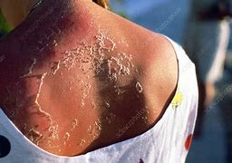 Image result for SunBurn On Back