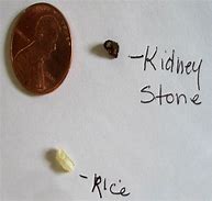 Image result for 7 Millimeter Kidney Stone