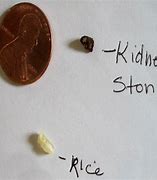 Image result for 6Mm Kidney Stone Actual Size