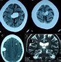 Image result for Meningioma Brain Tumor CT Scan