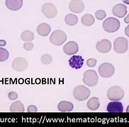 Image result for Hemoglobin H