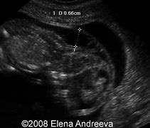 Image result for Meningocele Fetal Ultrasound