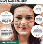 Image result for Acne