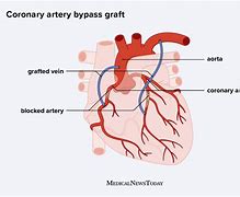 Image result for Heart Bypass Surgery Recovery