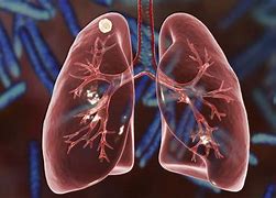Image result for Nodules in the Lungs
