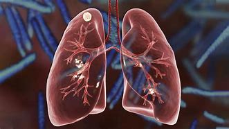 Image result for Nodules On Lungs