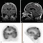 Image result for Meningioma Brain Tumor Dog MRI