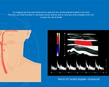 Image result for Carotid Doppler Ultrasound Anatomy