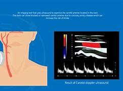 Image result for Carotid Artery Scan