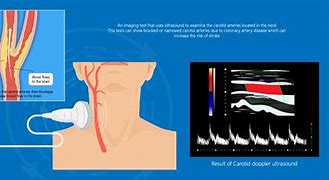 Image result for Carotid Artery Screeing