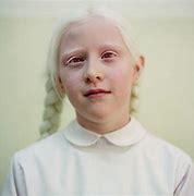 Image result for albinism0