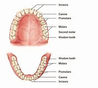 Image result for Wisdom Teeth Upper Jaw