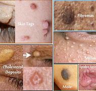 Image result for Papilloma Mole