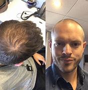 Image result for Bald Crown Haircut