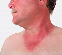 Image result for SunBurn Symptoms