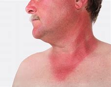 Image result for Skin Infection After Sun Burn