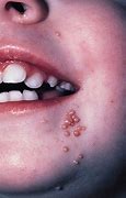 Image result for Molluscum On Face