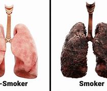 Image result for Black Lungs From Smoking Weed