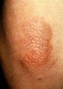 Image result for acrodermatitis_enteropathica