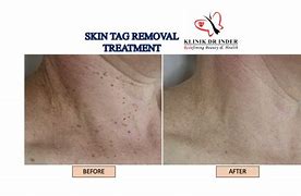 Image result for Cryo Skin Tag Remover