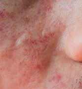 Image result for Dry Skin Rash On Face