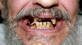 Image result for Meth Mouth
