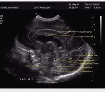 Image result for Corpus Callosum Fetal Ultrasound