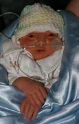 Image result for Baby Born with Anencephaly