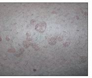 Image result for Warts On Upper Leg