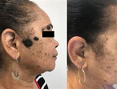 Image result for Mole Removal at Home