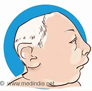 Image result for Anencephaly Adult