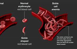 Image result for Sickle Cell Disease Early Symptoms
