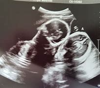 Image result for Twins at 20 Weeks