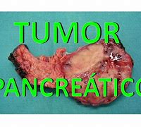 Image result for 21 Cm Tumor