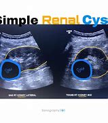 Image result for 8 Cm Cyst On Kidney