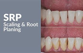 Image result for SRP Dental Before and After