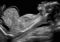 Image result for Omphalocele Birth Defect