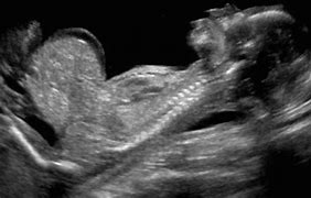 Image result for Omphalocele On Ultrasound