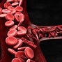 Image result for Sickle Cell Disease Symptoms