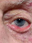 Image result for Prominent Ectropion