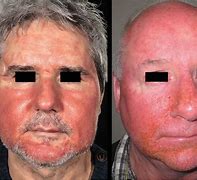 Image result for Face Allergy